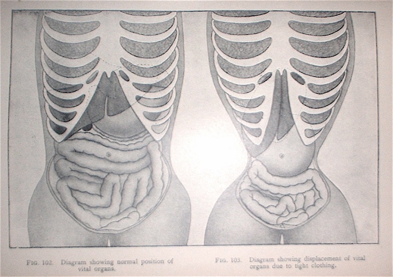 Kristin Holt | Corsets in the Era: Yes, even Maternity Corsets. Image is a diagram (of antiquity) showing in figures 102 "normal position of vital orans", and figure 103 "diagram showing displacement of vital orans due to tight clothing."