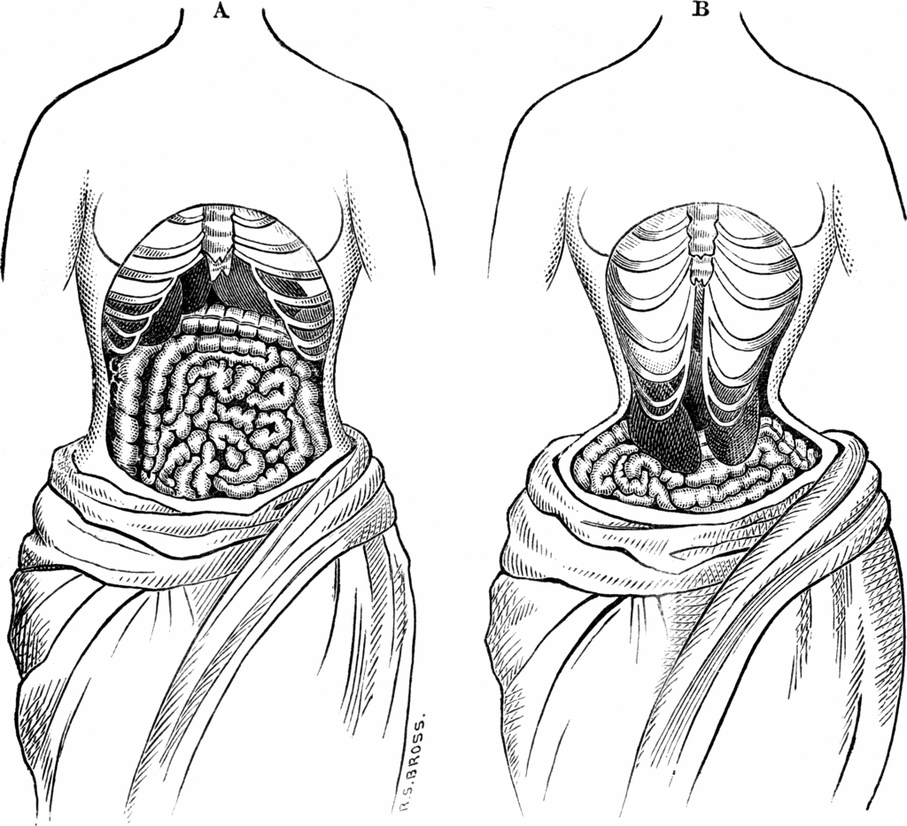 Kristin Holt | Defect in Form: Evils of Tight Lacing (a.k.a. Corsets), 1897. Two sketches from 1884 depicting what, at the time, was believed the way the inside of the body looked when wearing a corset (also a natural female midsection), including distortion of organs.