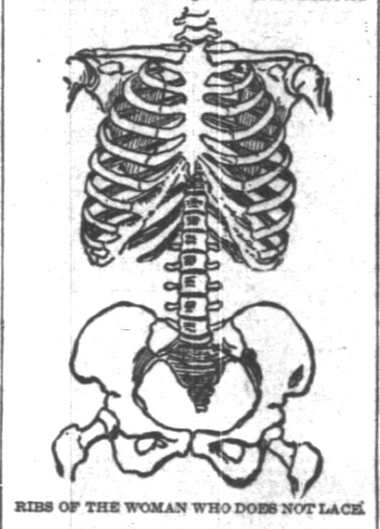 Kristin Holt | Defect in Form: Evils of Tight Lacing (a.k.a. Corsets), 1897. From Chicago Daily Tribune of Chicago, Illinois on April 24, 1897: Shows Defect in Form... may induce women to drop corsets. (Part 3 of 10)