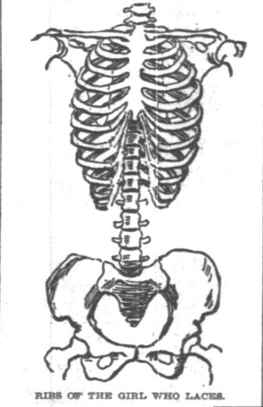 Kristin Holt | Defect in Form: Evils of Tight Lacing (a.k.a. Corsets), 1897. From Chicago Daily Tribune of Chicago, Illinois on April 24, 1897: Shows Defect in Form... may induce women to drop corsets. (Part 4 of 10)